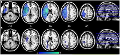 Longitudinal changes in functional connectivity in speech motor networks in apraxia of speech after stroke